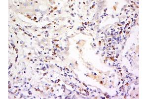 Paraformaldehyde-fixed, paraffin embedded human lung cancer, Antigen retrieval by boiling in sodium citrate buffer (pH6) for 15min, Block endogenous peroxidase by 3% hydrogen peroxide for 30 minutes, Blocking buffer (normal goat serum) at 37°C for 20min, Antibody incubation with Rabbit Anti-CD94/KLRD1 Polyclonal Antibody, Unconjugated  at 1:500 overnight at 4°C, followed by a conjugated secondary and DAB staining.