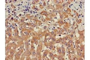 Immunohistochemistry of paraffin-embedded human liver cancer using ABIN7169681 at dilution of 1:100