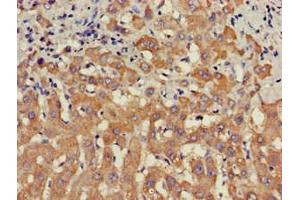 Immunohistochemistry of paraffin-embedded human liver cancer using ABIN7169681 at dilution of 1:100 (STAT4 anticorps  (AA 569-748))