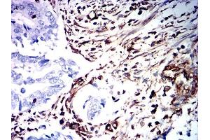 Immunohistochemical analysis of paraffin-embedded rectum cancer tissues using VIM mouse mAb with DAB staining. (Vimentin anticorps  (AA 2-466))
