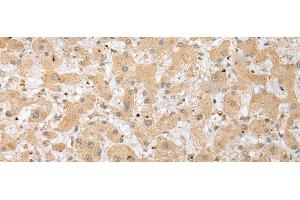 Immunohistochemistry of paraffin-embedded Human liver cancer tissue using DHRSX Polyclonal Antibody at dilution of 1:30(x200) (DHRSX anticorps)