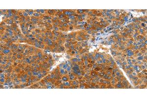 Immunohistochemistry of paraffin-embedded Human liver cancer using VWA5A Polyclonal Antibody at dilution of 1:60 (VWA5A anticorps)
