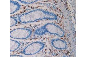 DAB staining on IHC-P; Samples: Human Rectum Cancer Tissue (TPSAB1 anticorps  (AA 161-262))
