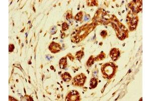 Immunohistochemistry of paraffin-embedded human breast cancer using ABIN7171277 at dilution of 1:100 (SDCBP2 anticorps  (AA 11-207))