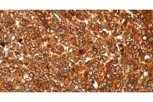 Immunohistochemistry of paraffin-embedded Human ovarian cancer using ALDOA Polyclonal Antibody at dilution of 1:30 (ALDOA anticorps)