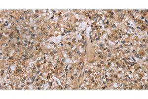 Immunohistochemistry of paraffin-embedded Human prostate cancer tissue using RAB39B Polyclonal Antibody at dilution 1:45 (RAB39B anticorps)