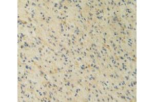 IHC-P analysis of Human Glioma Tissue, with DAB staining. (IL12A anticorps  (AA 23-219))