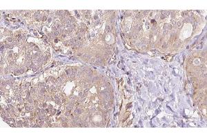 ABIN6273317 at 1/100 staining Human thyroid cancer tissue by IHC-P. (SGCG anticorps  (C-Term))