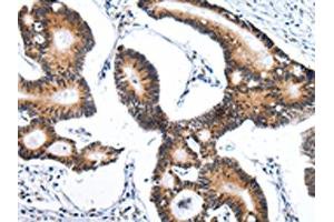 The image on the left is immunohistochemistry of paraffin-embedded Human tonsil tissue using ABIN7193115(ZNF473 Antibody) at dilution 1/30, on the right is treated with synthetic peptide. (ZNF473 anticorps)