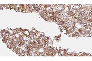 ABIN6272348 at 1/100 staining Human liver cancer tissue by IHC-P. (CDC42BPB anticorps  (C-Term))