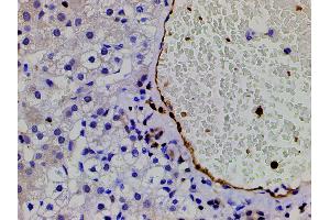 ABIN6267443 at 1/200 staining human vascular cancer tissue sections by IHC-P.