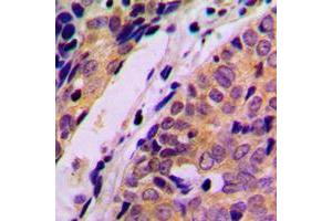 Immunohistochemical analysis of HARS staining in human breast cancer formalin fixed paraffin embedded tissue section. (HARS1/Jo-1 anticorps  (C-Term))