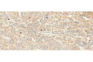 Immunohistochemistry of paraffin-embedded Human liver cancer tissue using WDFY4 Polyclonal Antibody at dilution of 1:50(x200) (WDFY4 anticorps)