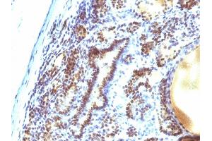 Formalin-fixed, paraffin-embedded human Thyroid Carcinoma stained with MAP3K1 Mouse Monoclonal Antibody (2F6).