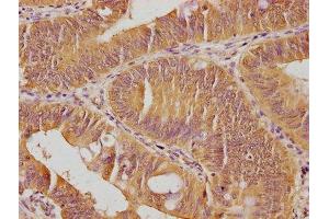 IHC image of ABIN7140147 diluted at 1:100 and staining in paraffin-embedded human colon cancer performed on a Leica BondTM system.