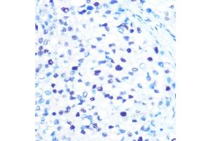 Immunohistochemistry of paraffin-embedded human liver cancer using MCM3 Rabbit mAb (ABIN7268540) at dilution of 1:100 (40x lens).