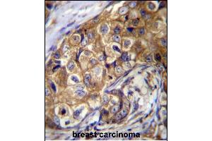 CTAGE5 Antibody (C-term) (ABIN656676 and ABIN2845915) immunohistochemistry analysis in formalin fixed and paraffin embedded human breast carcinoma followed by peroxidase conjugation of the secondary antibody and DAB staining.