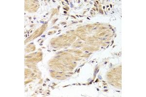 Immunohistochemistry of paraffin-embedded Human gastric cancer using CASP2 antibody at dilution of 1:100 (x400 lens). (Caspase 2 anticorps)