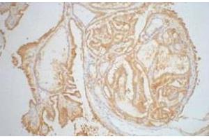 Immunohistochemistry of paraffin-embedded Human thyroid tissue using Galectin 3 Monoclonal Antibody at dilution of 1:200.