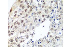 Immunohistochemistry of paraffin-embedded Human lung cancer using PTTG1 Polyclonal Antibody at dilution of 1:100 (40x lens). (PTTG1 anticorps)