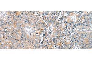 Immunohistochemistry of paraffin-embedded Human prost at e cancer tissue using COMMD6 Polyclonal Antibody at dilution of 1:45(x200) (COMMD6 anticorps)