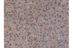 Detection of HBb in Human Liver cancer Tissue using Polyclonal Antibody to Hemoglobin Beta (HBb)