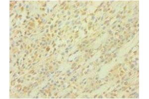 Immunohistochemistry of paraffin-embedded human breast cancer using ABIN7164283 at dilution of 1:100