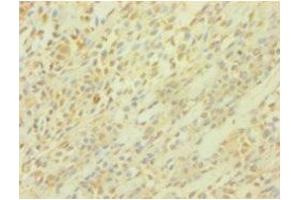 Immunohistochemistry of paraffin-embedded human breast cancer using ABIN7164283 at dilution of 1:100 (PICK1 anticorps  (AA 1-200))