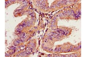 Immunohistochemistry of paraffin-embedded human endometrial cancer using ABIN7164713 at dilution of 1:100 (Prokineticin Receptor 2 anticorps  (AA 1-45))