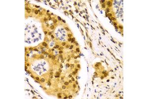Immunohistochemistry of paraffin-embedded Human gastric cancer using ELAVL1 antibody at dilution of 1:100 (x400 lens).