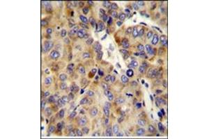 Formalin fixed and paraffin embedded human hepatocarcinoma stained with COL18A1 Antibody (Center) Cat. (COL18A1 anticorps  (Chain alpha 1, Middle Region))