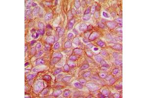 Immunohistochemical analysis of PKC delta (pT507) staining in human breast cancer formalin fixed paraffin embedded tissue section. (PKC delta anticorps  (pSer507))