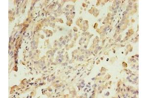 Immunohistochemistry of paraffin-embedded human lung cancer using ABIN7144550 at dilution of 1:100 (GIT2 anticorps  (AA 1-603))