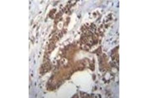 Immunohistochemistry analysis in formalin fixed and paraffin embedded human colon carcinoma reacted with PCYT1A Antibody (N-term) followed by peroxidase conjugation of the secondary antibody and DAB staining. (PCYT1A anticorps  (N-Term))