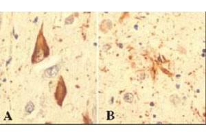 Immunohistochemical staining of RPS27A in hippocampal tissue from an Alzheimer patient, using RPS27A monoclonal antibody, clone Ubi-1 . (RPS27A anticorps)