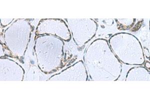 Immunohistochemistry of paraffin-embedded Human thyroid cancer tissue using POMC Polyclonal Antibody at dilution of 1:35(x200) (POMC anticorps)