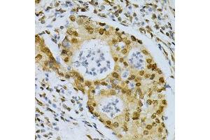 Immunohistochemistry of paraffin-embedded human gastric cancer using ELAVL1 Antibody.