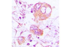 Immunohistochemical analysis of Cathepsin H staining in human lung cancer formalin fixed paraffin embedded tissue section. (Cathepsin H anticorps  (Center))