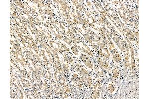 ABIN6263325 and ABIN6279013 at 1/100 staining human colorectal cancer and adjacent non-tumor tissue by IHC-P. (MOGAT3 anticorps  (C-Term))
