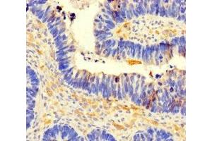 Immunohistochemistry of paraffin-embedded human ovarian cancer using ABIN7148136 at dilution of 1:100 (CCDC66 anticorps  (AA 87-286))