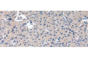 Immunohistochemistry of paraffin-embedded Human liver cancer using RAB2A Polyclonal Antibody at dilution of 1/40 (RAB2A anticorps)