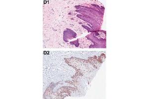 Immunohistochemical analysis of PDCD4 shows the corresponding H&E-stained and PDCD4-stained tissue sections from patients with OSCC.