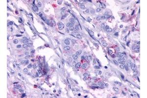 Immunohistochemical staining of Colon carcinoma (Neoplastic cells) using anti- GPR124 antibody ABIN122437 (GPR124 anticorps)