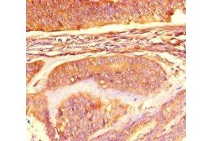 Immunohistochemistry of paraffin-embedded human endometrial cancer using ABIN7160847 at dilution of 1:100 (NAD-ME anticorps  (AA 296-424))