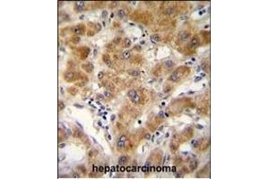 ODF3B antibody (N-term) (ABIN654768 and ABIN2844448) immunohistochemistry analysis in formalin fixed and paraffin embedded human hepatocarcinoma followed by peroxidase conjugation of the secondary antibody and DAB staining. (ODF3B anticorps  (N-Term))