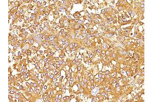 Formalin-fixed, paraffin-embedded human Melanoma stained with gp100 / Melanosome Monoclonal Antibody (SPM142). (Melanoma gp100 anticorps)