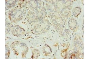 Immunohistochemistry of paraffin-embedded human breast cancer using ABIN7173225 at dilution of 1:100 (TMEM45A anticorps  (AA 171-217))