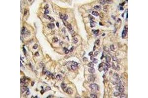 IHC analysis of FFPE human lung carcinoma tissue stained with CSF1R antibody (CSF1R anticorps  (AA 940-971))