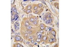 IHC analysis of FFPE human breast carcinoma tissue stained with HSPB1 antibody