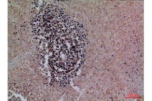 Immunohistochemistry (IHC) analysis of paraffin-embedded Human Lung Cancer, antibody was diluted at 1:100. (Surfactant Protein A1 anticorps  (Internal Region))